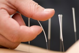 Acupuncture